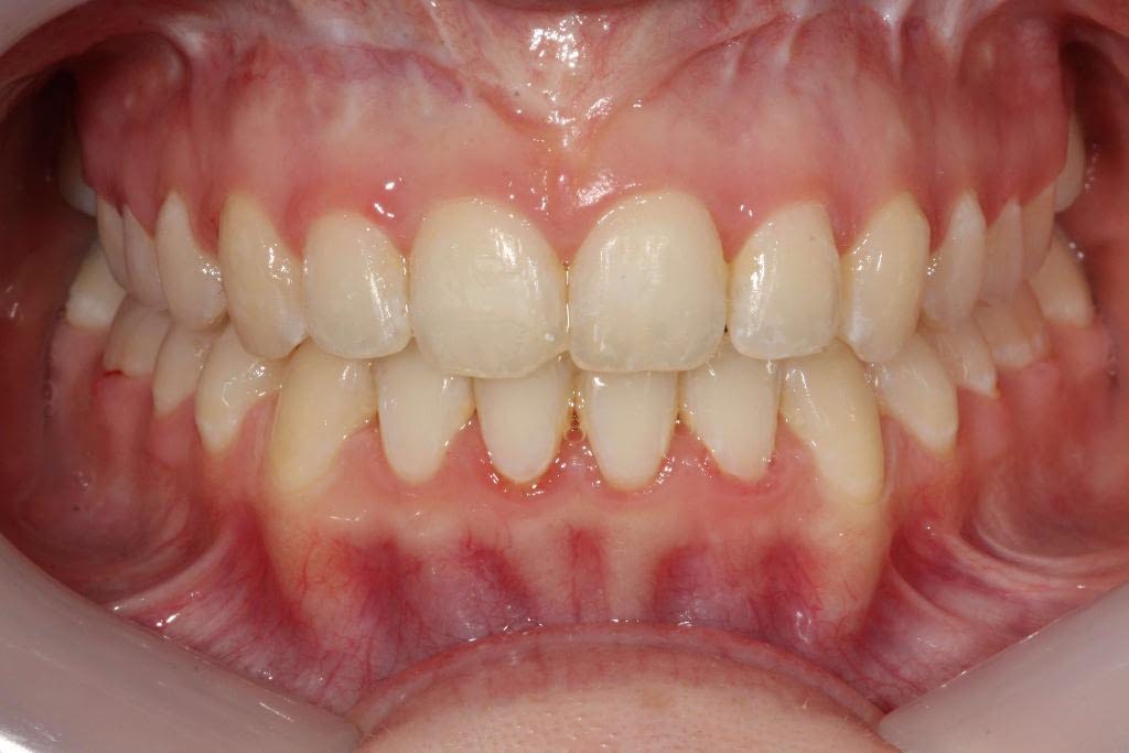 Anterior Openbites Align Dentistry Blog Call (02) 9723 5757