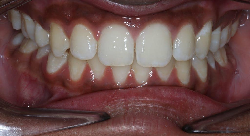 eatment of large Overjet and Overbite case treated by Dr Anand Align